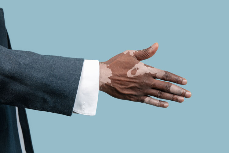 人特写男性手白癜风色素隔离蓝色背景特殊皮肤男性版面握手