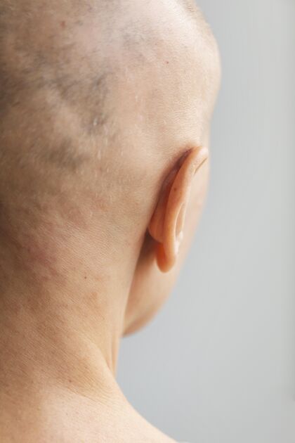女人皮肤癌的女人健康秃头保健